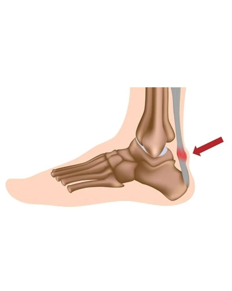 Medical Brace Ελαστική Επιστραγαλίδα με Σιλικόνη Achiless